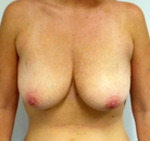  Bandingkan Sebelum & Sesudah Foto Pengecilan Payudara