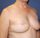 Bandingkan Sebelum & Sesudah Foto Rekonstruksi Payudara