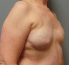 Bandingkan Sebelum & Sesudah Foto Rekonstruksi Payudara