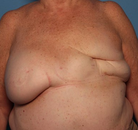 Bandingkan Sebelum & Sesudah Foto Rekonstruksi Payudara