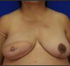 Bandingkan Sebelum & Sesudah Foto Rekonstruksi Payudara