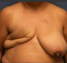 Bandingkan Sebelum & Sesudah Foto Rekonstruksi Payudara