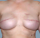 Bandingkan Sebelum & Sesudah Foto Rekonstruksi Payudara