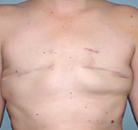 Bandingkan Sebelum & Sesudah Foto Rekonstruksi Payudara