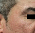 Bandingkan Sebelum & Sesudah Foto Penghapusan Tato dengan Laser