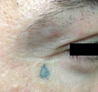 Bandingkan Sebelum & Sesudah Foto Penghapusan Tato dengan Laser