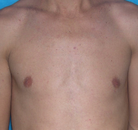  Bandingkan Sebelum & Sesudah Foto Penghapusan Rambut Laser