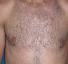  Bandingkan Sebelum & Sesudah Foto Penghapusan Rambut Laser