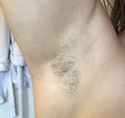  Bandingkan Sebelum & Sesudah Foto Penghapusan Rambut Laser