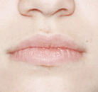  Bandingkan Sebelum & Sesudah Foto Penghapusan Rambut Laser