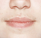  Bandingkan Sebelum & Sesudah Foto Penghapusan Rambut Laser