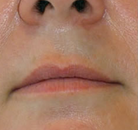  Bandingkan Sebelum & Sesudah Foto Penghapusan Rambut Laser