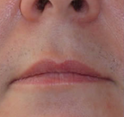  Bandingkan Sebelum & Sesudah Foto Penghapusan Rambut Laser