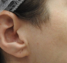  Bandingkan Sebelum & Sesudah Foto Penghapusan Rambut Laser