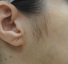  Bandingkan Sebelum & Sesudah Foto Penghapusan Rambut Laser