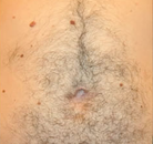  Bandingkan Sebelum & Sesudah Foto Penghapusan Rambut Laser