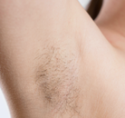  Bandingkan Sebelum & Sesudah Foto Penghapusan Rambut Laser