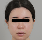  Bandingkan Sebelum & Sesudah Foto Pembentukan Rahang