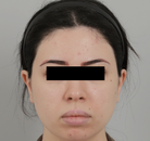  Bandingkan Sebelum & Sesudah Foto Pembentukan Rahang