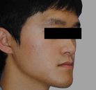  Bandingkan Sebelum & Sesudah Foto Pembentukan Rahang