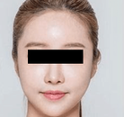  Bandingkan Sebelum & Sesudah Foto Pembentukan Rahang