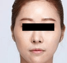  Bandingkan Sebelum & Sesudah Foto Pembentukan Rahang