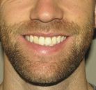  Bandingkan Sebelum & Sesudah Foto Pembentukan Rahang