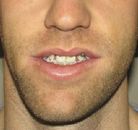  Bandingkan Sebelum & Sesudah Foto Pembentukan Rahang