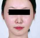  Bandingkan Sebelum & Sesudah Foto Pembentukan Rahang