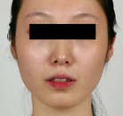  Bandingkan Sebelum & Sesudah Foto Pembentukan Rahang