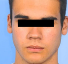  Bandingkan Sebelum & Sesudah Foto Pembentukan Rahang