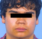  Bandingkan Sebelum & Sesudah Foto Pembentukan Rahang