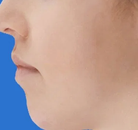  Bandingkan Sebelum & Sesudah Foto Pembentukan Rahang