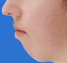  Bandingkan Sebelum & Sesudah Foto Pembentukan Rahang