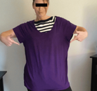  Bandingkan Sebelum & Sesudah Foto Operasi Bypass Lambung