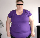  Bandingkan Sebelum & Sesudah Foto Operasi Bypass Lambung