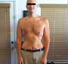  Bandingkan Sebelum & Sesudah Foto Operasi Bypass Lambung