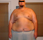  Bandingkan Sebelum & Sesudah Foto Operasi Bypass Lambung