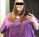  Bandingkan Sebelum & Sesudah Foto Operasi Bypass Lambung