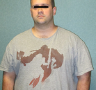  Bandingkan Sebelum & Sesudah Foto Operasi Bypass Lambung