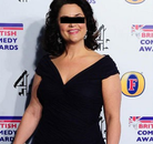 Bandingkan Sebelum & Sesudah Foto Operasi Ikat Lambung