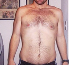 Bandingkan Sebelum & Sesudah Foto Operasi Ikat Lambung