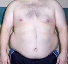 Bandingkan Sebelum & Sesudah Foto Operasi Ikat Lambung