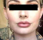  Bandingkan Sebelum & Sesudah Foto Augmentasi Bibir