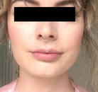  Bandingkan Sebelum & Sesudah Foto Augmentasi Bibir