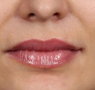  Bandingkan Sebelum & Sesudah Foto Augmentasi Bibir