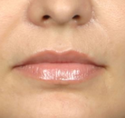  Bandingkan Sebelum & Sesudah Foto Augmentasi Bibir