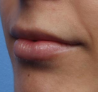  Bandingkan Sebelum & Sesudah Foto Augmentasi Bibir