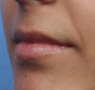  Bandingkan Sebelum & Sesudah Foto Augmentasi Bibir