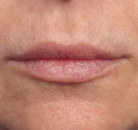  Bandingkan Sebelum & Sesudah Foto Augmentasi Bibir